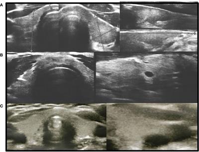 New insights into thyroid dysfunction in patients with inactivating parathyroid hormone/parathyroid hormone-related protein signalling disorder (the hormonal and ultrasound aspects): One-centre preliminary results